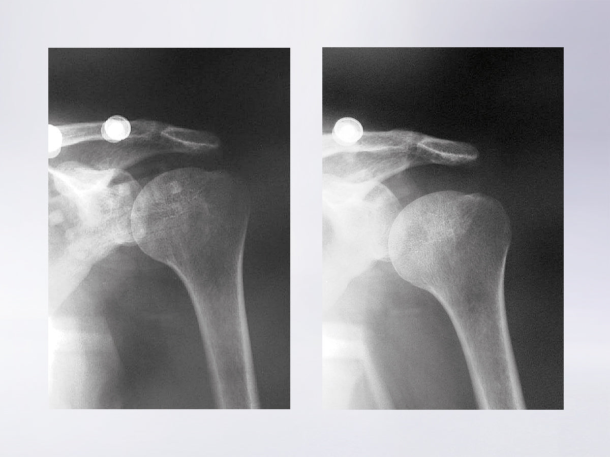 Neuro-Lux II shoulder and arm support orthosis after stroke for example