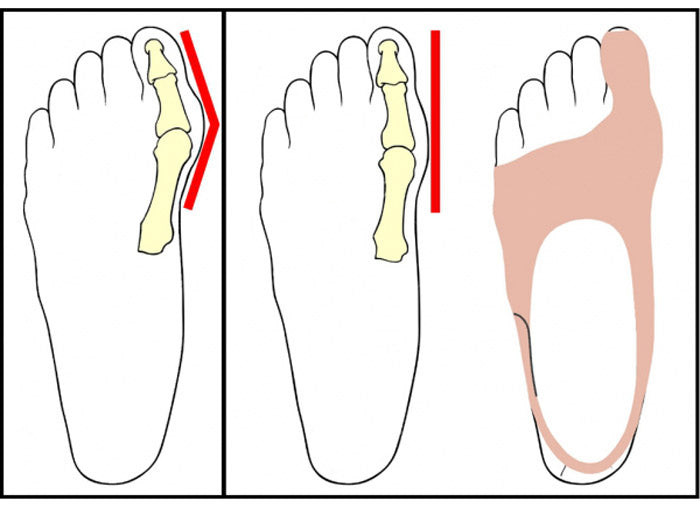 Correcteur d'Hallux-Valgus pour le jour Gourallux