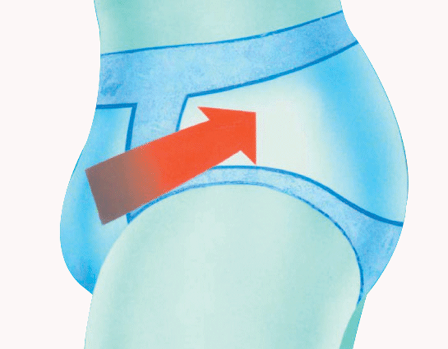 Slip pour réduction des hernies inguinales pour homme ErniaSlip 1 avec pelotes goural
