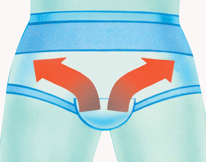 ErniaSlip lady light abdominal support and inguinal hernia reduction briefs with goural pads (corrected version)