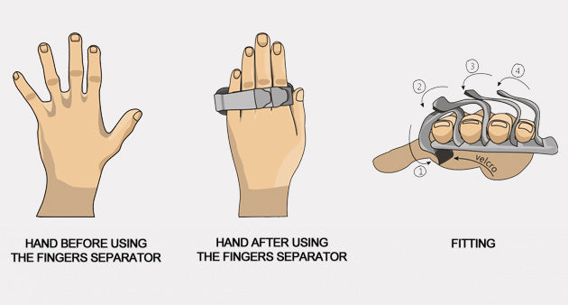 Finger separator for PMD hand orthoses (Alufix progress)